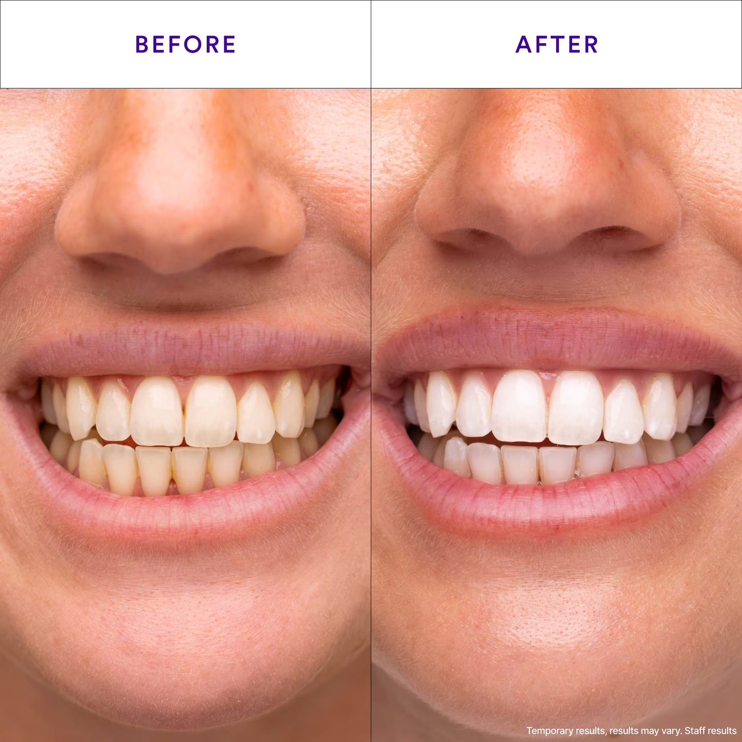 Tiras Blanqueadoras de Dientes Moradas